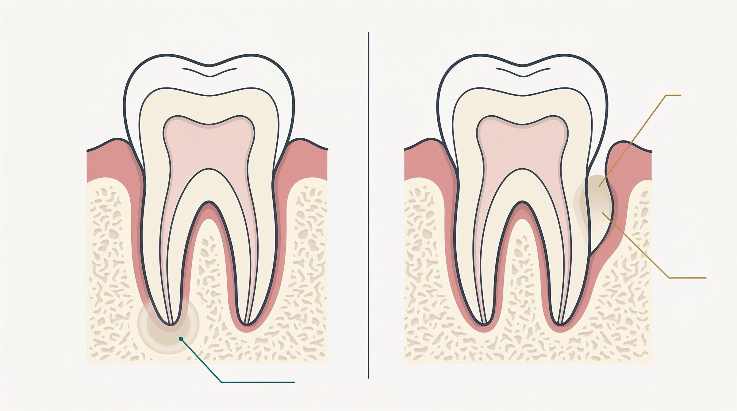 IMAGE FORMAT: Generate and export strictly as a PNG file. PNG format only. Do not output JPEG, JPG, JFIF, WEBP or GIF. Single static still image, minimum 1600px wide. A clean medical cross section showing a single molar in vertical section, drawn twice side by side for comparison, separated by a thin vertical rule. LEFT TOOTH: the infection sits as a soft rounded pale halo at the very tip of the root, inside the cream coloured bone. A fine teal leader line runs from it outward to a label position. RIGHT TOOTH: the tooth itself is healthy, and the infection sits instead in a deep pocket alongside the root, between tooth and gum, shown as a pale pocket in the muted pink gum tissue. A gold leader line runs from it outward. Both teeth: cream jawbone with fine trabecular texture, muted pink gum, natural tooth silhouette, visible pulp chamber in soft outline. Style: precise anatomical medical illustration in a modern editorial register. Accurate structure, simplified, clean and unthreatening. Smooth flat shading with subtle depth. Absolutely no blood, no pus rendering, no gore, no instruments. The register of a good patient education leaflet. Palette: teal #0F6B73, gold #C0873A, muted pink gum, cream bone, charcoal #243447 linework, off-white background.